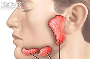 Xuất hiện dấu hiệu này bạn nên nghĩ đến ung thư tuyến nước bọt